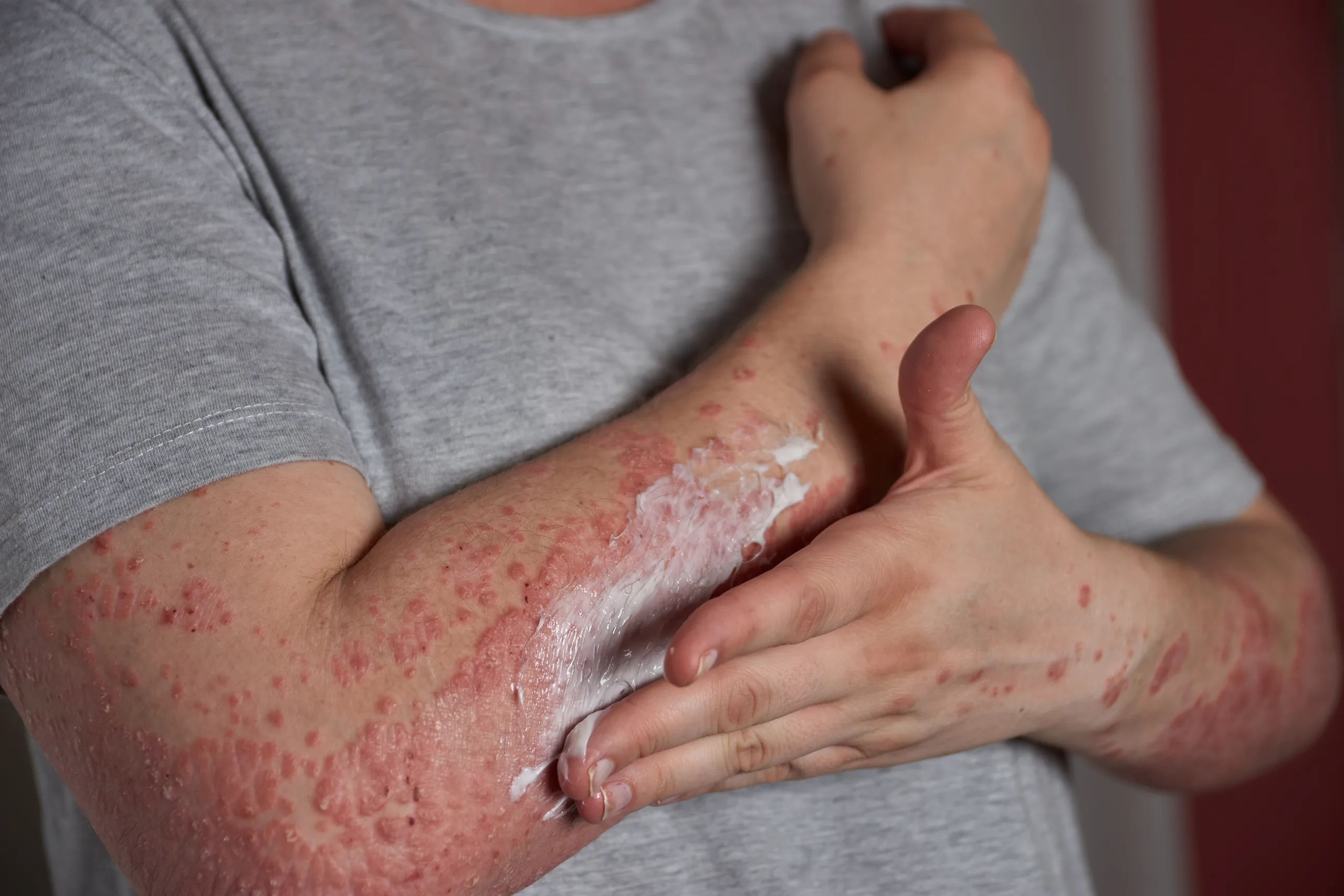 applying moisturizer skin with psoriasis scaled