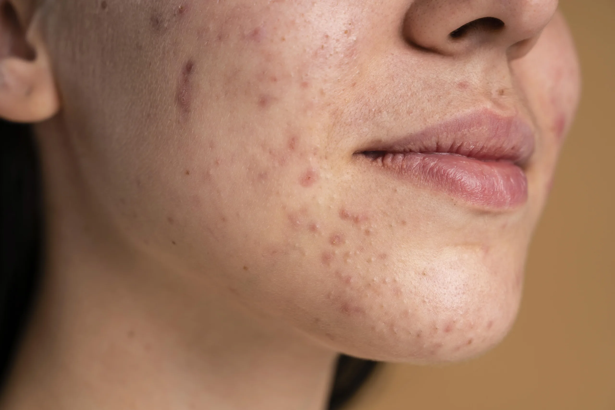 confident young woman with acne close up scaled