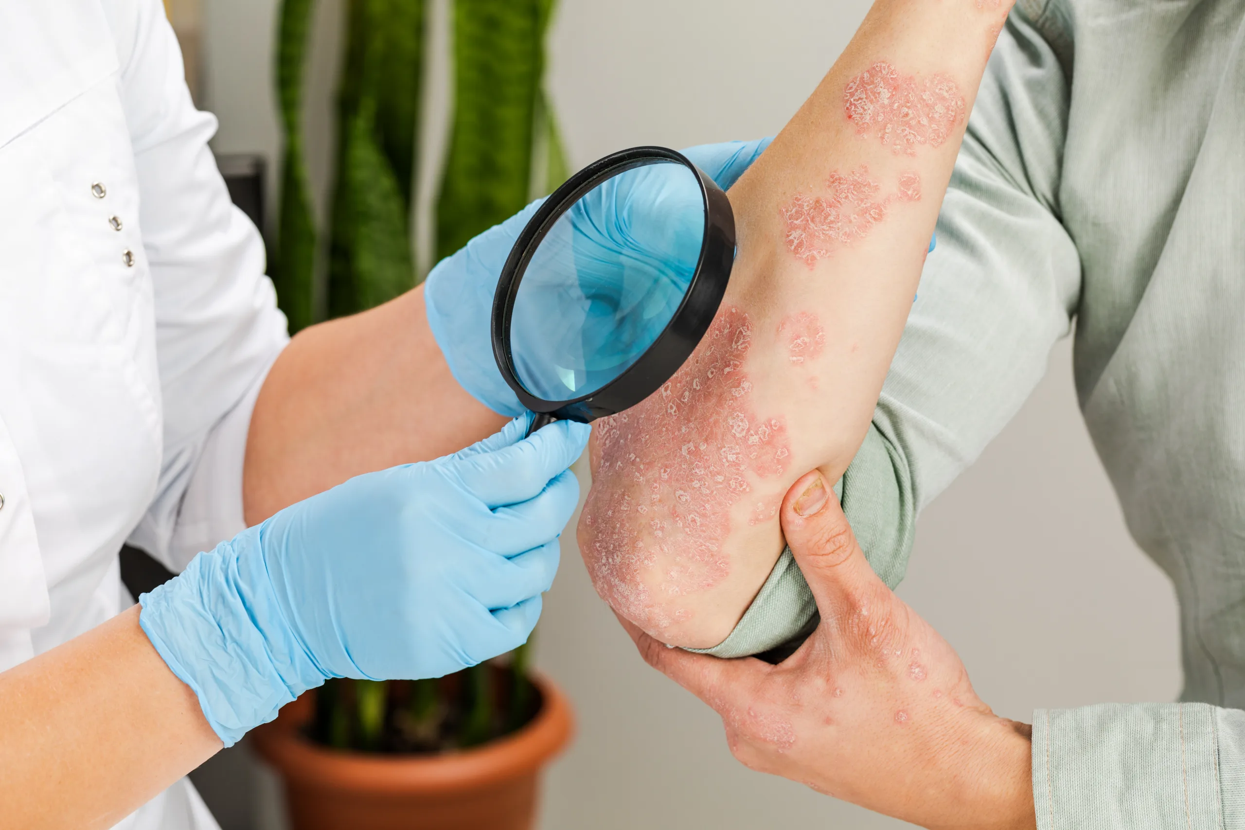 dermatologist wearing gloves examines skin sick patient examination diagnosis skin diseases allergies psoriasis eczema dermatitis scaled