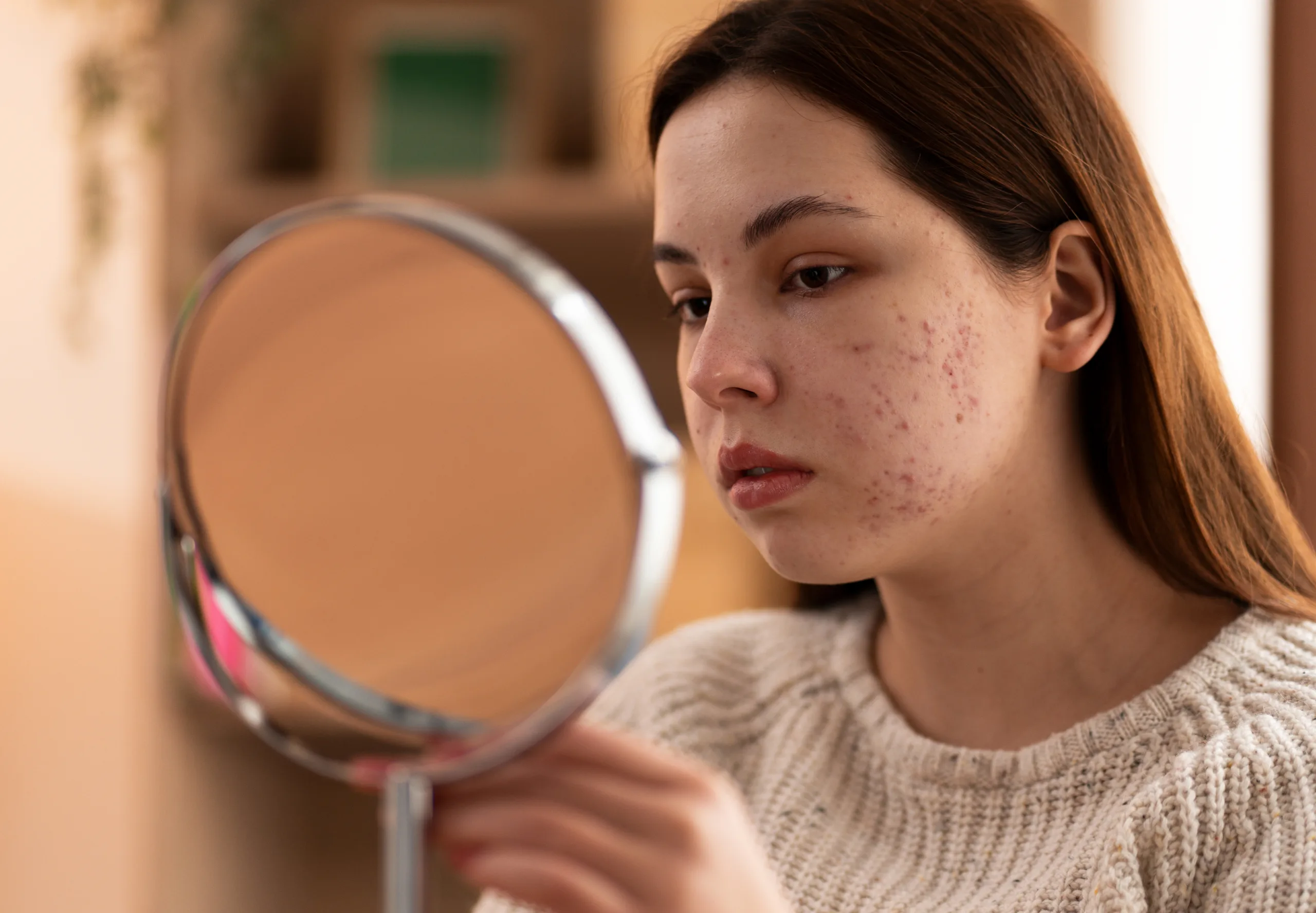 person dealing with rosacea 3 scaled