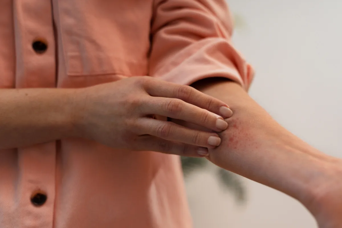 person dealing with rosacea 4