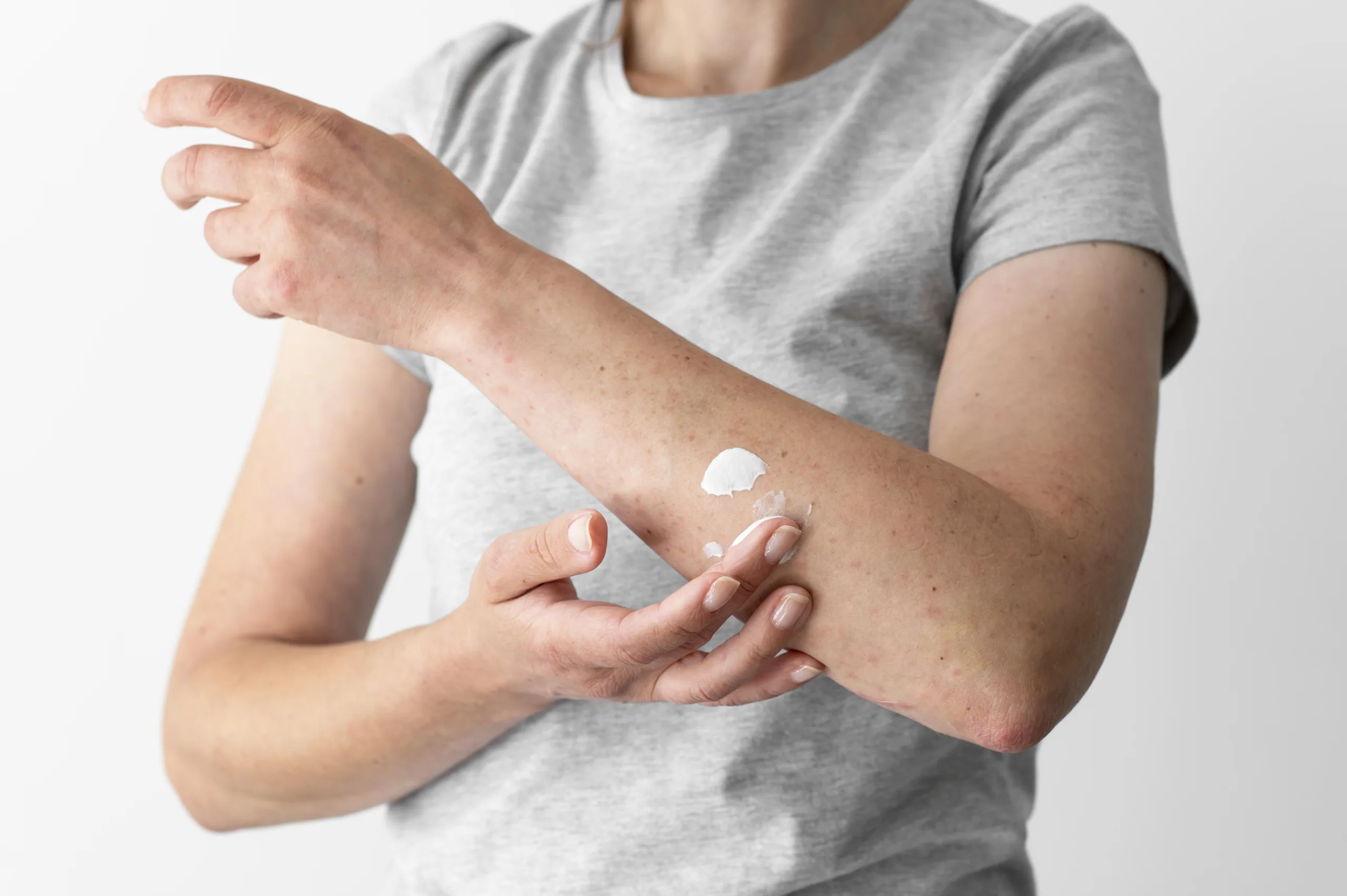 skin allergy reaction person s arm scaled